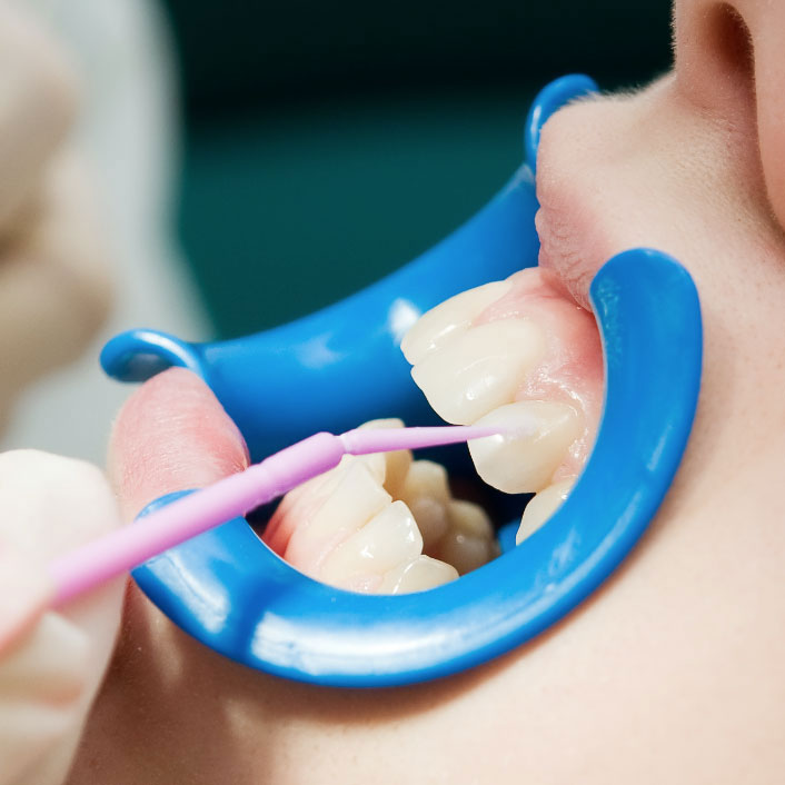 Sealants - Dental Services